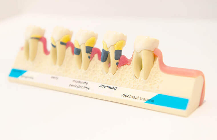 歯周病で失った骨を再生 再生医療への取り組み