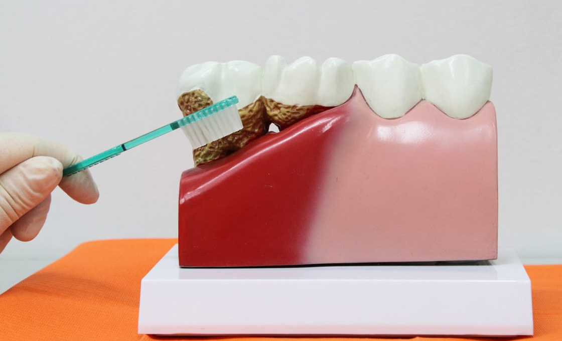 歯周病治療後の再発防止